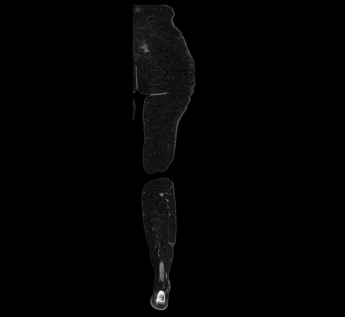 CTA lower limb coronal cross sectional anatomy labelled image _87 (2).webp
